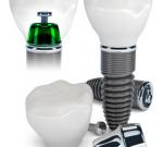 Dental Implants